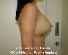 plastic-surgery-breast-augmentation